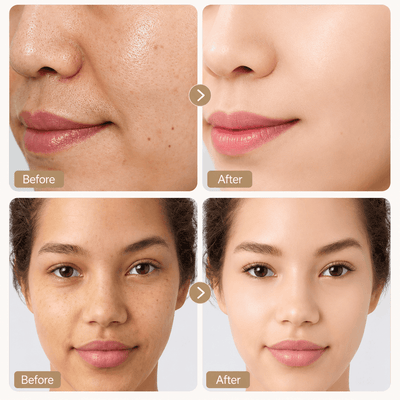 Before and after comparison of facial skin treatment on a woman's face.